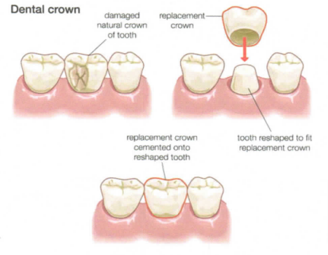 Crown Explanation 1 pdf